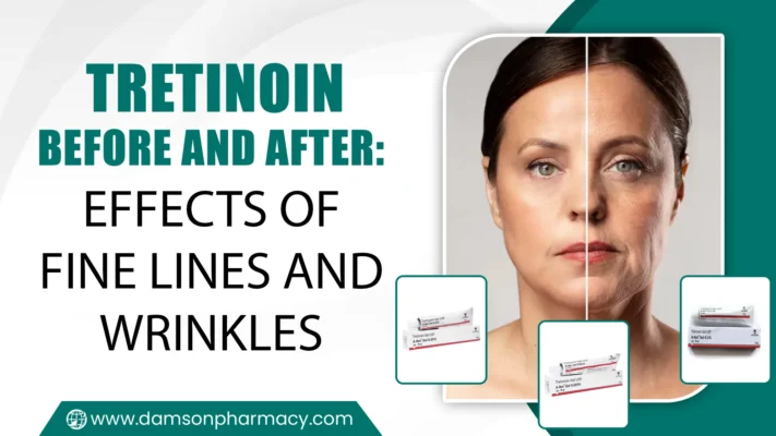 Tretinoin Before and After Effects of Fine Lines and Wrinkles